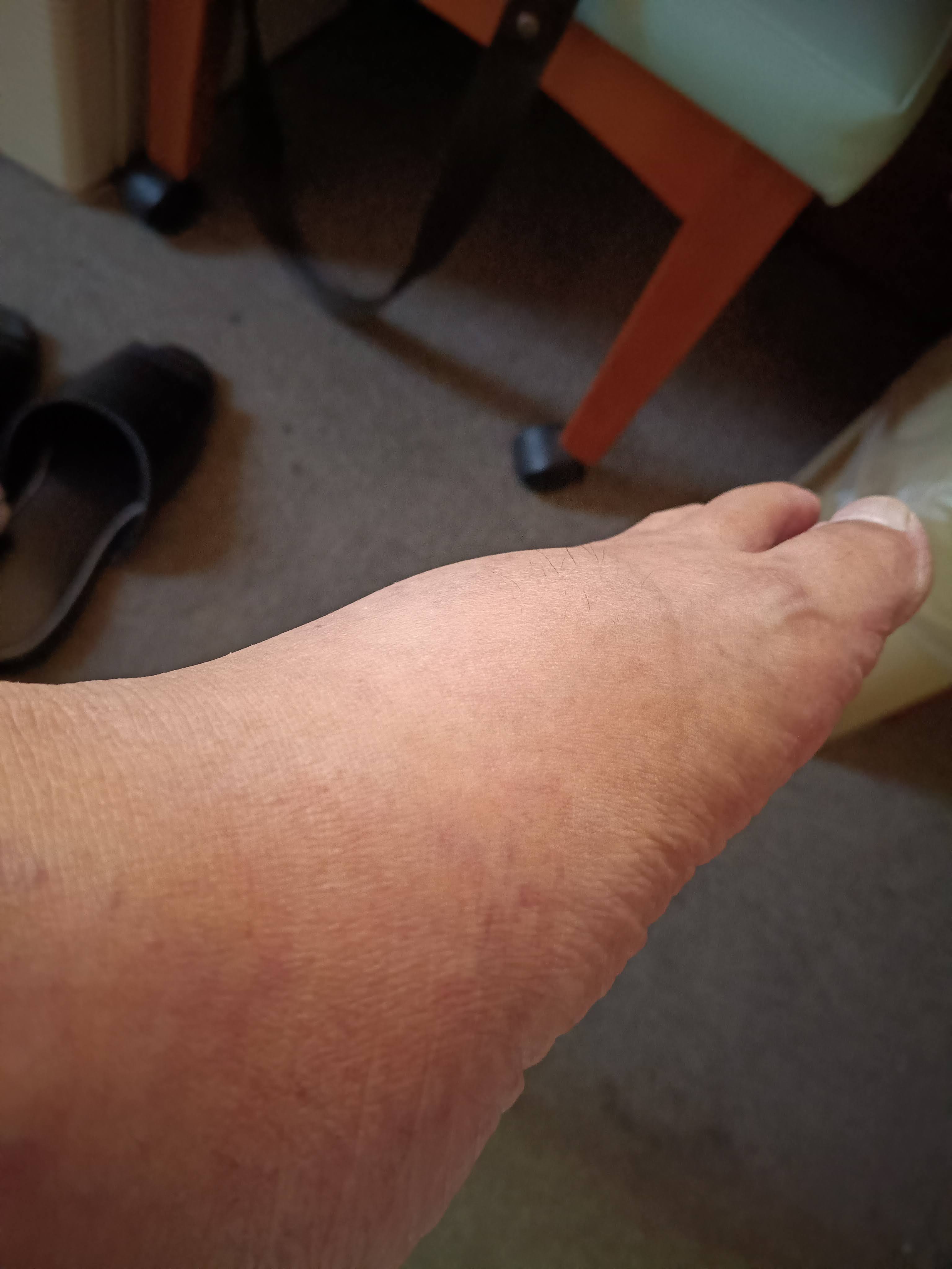 足の甲の浮腫み1